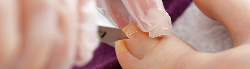 KosMed - leczenie wrastających paznokci
